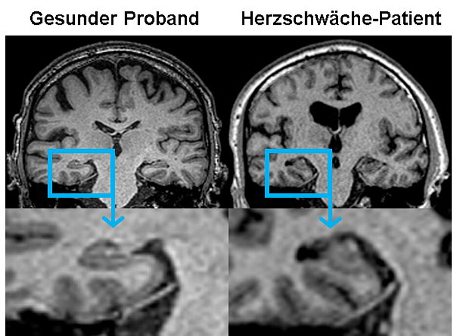 The MRI scans show differences in the brains of healthy participants (left) and patients with congestive heart failure. (Picture: CHFC Würzburg)