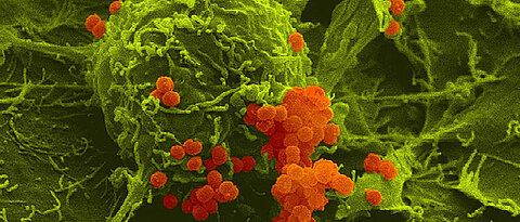 False color scanning electron micrograph of meningococci (orange) adherent to human host cells (green).