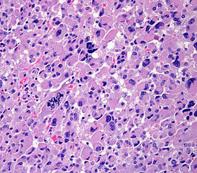 Gewebe eines Nebennierenkarzinom-Schnittes unter dem Mikroskop. Die blauen Bereiche sind die Zellkerne und das Zytoplasma ist lila eingefärbt. Bild: Uniklinikum Würzburg.
