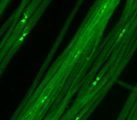 In patients with antibodies against Caspr, the structure of the Nodes of Ranvier is destroyed and nerve function is severely impaired.