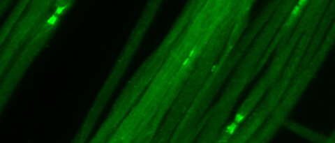 In patients with antibodies against Caspr, the structure of the Nodes of Ranvier is destroyed and nerve function is severely impaired.