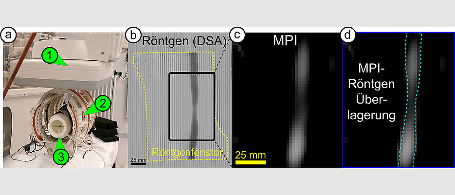 Der iMPI-Scanner (links) ermöglicht neue Einblicke in den menschlichen Körper. Hier zu sehen ist eine Engstelle in einem Blutgefäß – aufgenommen mit konventionellen Röntgenstrahlen (b), mit dem Scanner (c) und in einer Kombination beider Techniken (d).