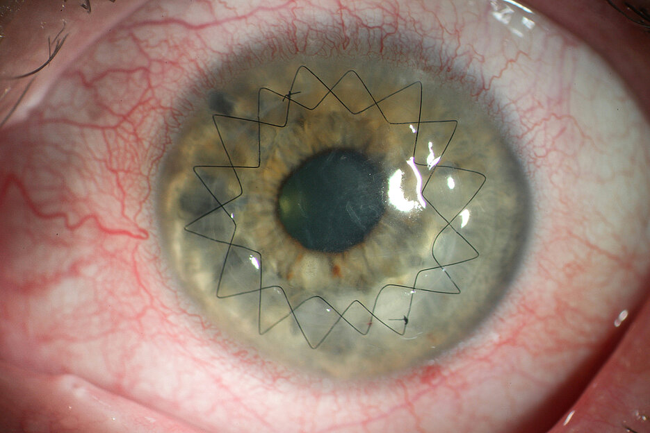 Wer nach dem Tod die Hornhäute seiner Augen spendet, hilft anderen Menschen: Bei diesem Patienten wurde wegen einer Narbe die zentrale Hornhaut durch ein mit feinen Nähten fixiertes Transplantat ersetzt.