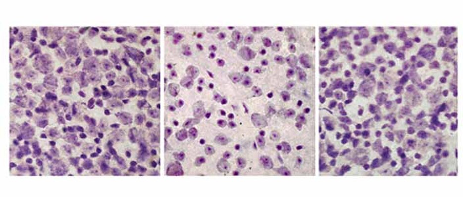 Retina degeneration can be slowed down in the mouse model for childhood dementia: The ganglion cells of a healthy retina on the left; a diseased retina in the centre. A diseased retina under treatment with teriflunomide on the right.