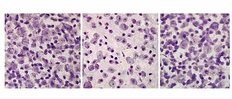 Retina degeneration can be slowed down in the mouse model for childhood dementia: The ganglion cells of a healthy retina on the left; a diseased retina in the centre. A diseased retina under treatment with teriflunomide on the right.