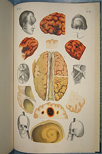 Auf diesem Bild wird das Gehirn mit verschiedenen Krankheiten dargestellt.