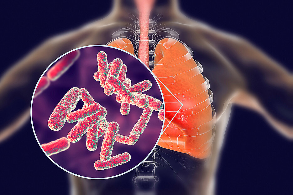 Tuberculosis is a highly contagious infectious disease that is typically spread through aerosols and mainly affects the lungs. Every year, an estimated 1.7 million people worldwide die from such an infection.