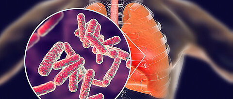 Tuberculosis is a highly contagious infectious disease that is typically spread through aerosols and mainly affects the lungs. Every year, an estimated 1.7 million people worldwide die from such an infection.