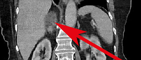 Randomly discovered adrenal gland tumour on the right side with a size of 5.1 centimetres.