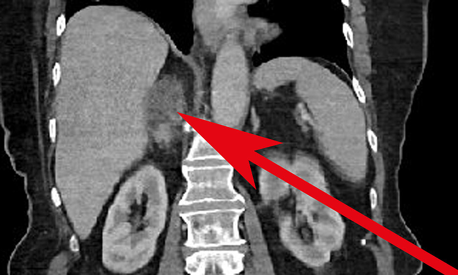 Randomly discovered adrenal gland tumour on the right side with a size of 5.1 centimetres.