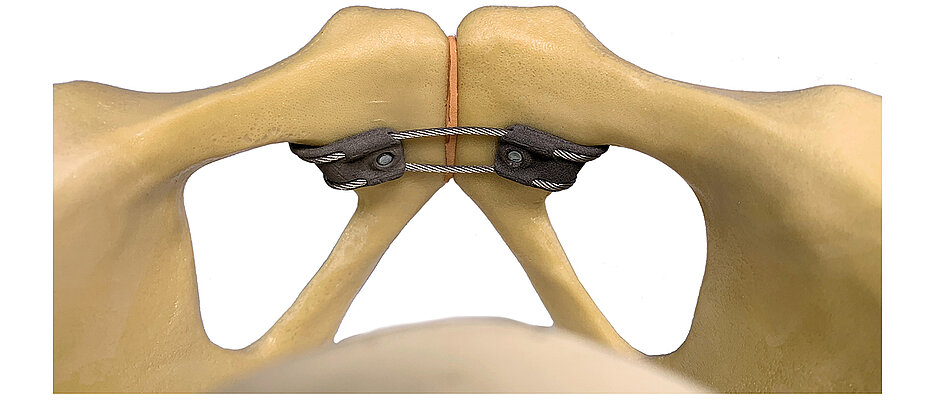 Unfallchirurgen des Uniklinikums Würzburg haben mit internen und externen Partnern aus der Region innovative Kabel-Klammer-Implantate zur Behandlung von Verletzungen des vorderen Beckenrings entwickelt. 