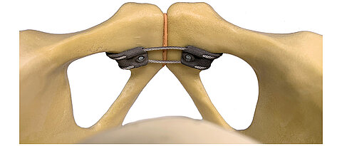 Unfallchirurgen des Uniklinikums Würzburg haben mit internen und externen Partnern aus der Region innovative Kabel-Klammer-Implantate zur Behandlung von Verletzungen des vorderen Beckenrings entwickelt. 