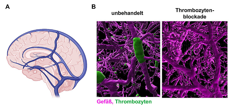 A)	Schematische Darstellung der großen Hirnvenen. B) Moderne Mikroskopieverfahren ermöglichen es, die Gerinnselbildung in den Hirnvenen von Mäusen darzustellen. Im linken Bild sind Gefäße einer erkrankten Maus zu sehen, wohingegen die rechten Bilder aus Mäusen stammen, deren Thrombozyten gehemmt wurden. (Bild: RVZ)