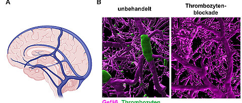 A) Schematic representation of the large cerebral veins. B) Modern microscopy techniques make it possible to visualize clot formation in the cerebral veins of mice. The left image shows vessels from a diseased mouse, whereas the right images are from mice whose platelets have been inhibited.