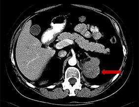 Computertomographie eines Nebennieren-Zufallstumors. (Foto: UKW)