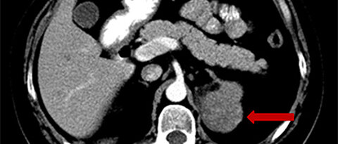 Computertomographie eines Nebennieren-Zufallstumors. (Foto: UKW)