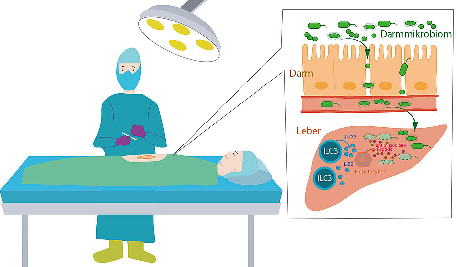 Nach einem operativen Eingriff können Bakterien aus dem Darm in den Organismus gelangen. Spezielle Zellen des Immunsystems, die in der Leber ansässig sind, bekämpfen sie. 