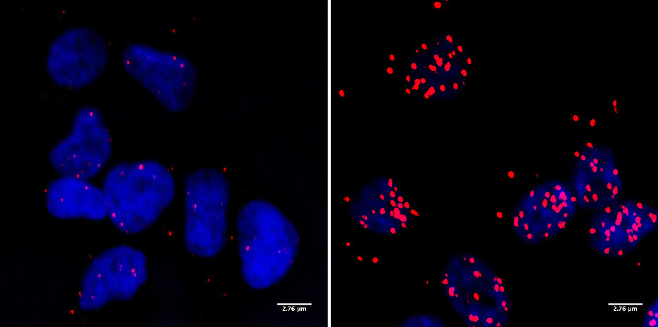 Zellen eines Neuroblastoms: Die roten Punkte markieren Stellen, an denen das BRCA1-Protein in engem Kontakt mit der RNA-Polymerase II vorkommt. Das ist nur dann der Fall, wenn auch das Protein MYCN vorliegt (rechtes Bild).