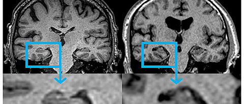The MRI scans show differences in the brains of healthy participants (left) and patients with congestive heart failure. (Picture: CHFC Würzburg)