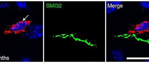 Microscopic picture of a CD8+ T cell in the CNS of a two-year-old mouse. The cytotoxic T cell (red labelling) is located in immediate proximity to a damaged nerve fiber (green labelling) and is, according to the described results, involved in its damage. The cell nuclei of all cell bodies in the image are labelled in blue. Scale bar: 20 µm. 