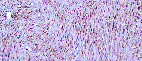 Cells of a classical mesoblastic nephroma under the microscope