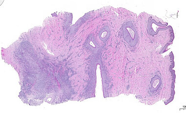 Das Gewebe einer Hidradenitis suppurativa (HS) im Stadium II–III wurde mit einer Hämatoxylin-Eosin-Färbung (HE-Färbung) histologisch untersucht