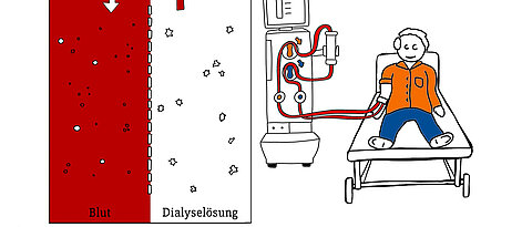 Bei der Dialyse wird das Blut von Giftstoffen gereinigt. Über die Spülflüssigkeit werden Substanzen aus dem Blut entfernt und im Gegenstromprinzip hinzugefügt.