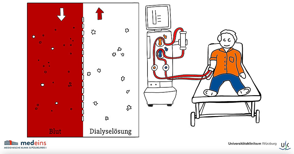 Bei der Dialyse wird das Blut von Giftstoffen gereinigt. Über die Spülflüssigkeit werden Substanzen aus dem Blut entfernt und im Gegenstromprinzip hinzugefügt.