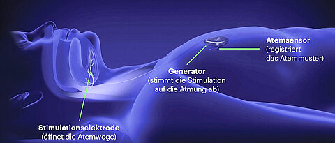 Aufbau und Funktionsweise des Zungenschrittmachers.