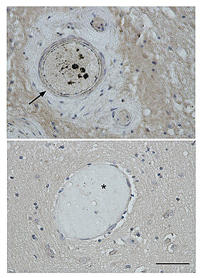 Patients with traumatic brain injury frequently have clotted blood vessels (arrow) that can impair supply of the brain and aggravate brain damage. In the brain tissue of healthy persons, the vessels are usually free of such deposits (asterisk).