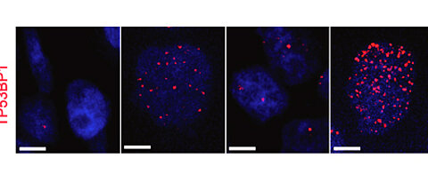 Das Bild zeigt den DNA-Schadensmarker TP53BP1 in Tumor-DNA. Das zweite Bild von links zeigt die Schäden an Tumorzellen, nach einer Behandlung mit Cisplatin. Das rechte Bild zeigt die Schäden an Tumorzellen, nach einer Reduktion von USP28 und einer Behandlung von Cisplatin. Es ist ein deutlicher Anstieg an Schäden an der Tumor-DANN zu beobachten.