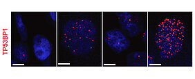 Das Bild zeigt den DNA-Schadensmarker TP53BP1 in Tumor-DNA. Das zweite Bild von links zeigt die Schäden an Tumorzellen, nach einer Behandlung mit Cisplatin. Das rechte Bild zeigt die Schäden an Tumorzellen, nach einer Reduktion von USP28 und einer Behandlung von Cisplatin. Es ist ein deutlicher Anstieg an Schäden an der Tumor-DANN zu beobachten.