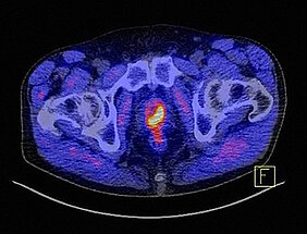 So markant lässt sich ein Prostatakarzinom unter Zuhilfenahme des Tracers PSMA im PET-CT als gelb-rotes Objekt darstellen. (Bild: Uniklinikum Würzburg)