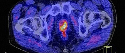 So markant lässt sich ein Prostatakarzinom unter Zuhilfenahme des Tracers PSMA im PET-CT als gelb-rotes Objekt darstellen. (Bild: Uniklinikum Würzburg)