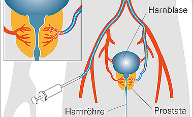Schematische Darstellung der Prostata-Arterienembolisation: Die eingebrachten Mikro-Kügelchen reduzieren die Durchblutung der Prostata.
