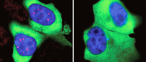 SMN is concentrated in the Cajal bodies (left, red) in the nucleus of human cells (blue). If phosphorylation of SMN is inhibited, the concentration ceases and Cajal bodies disappear. 