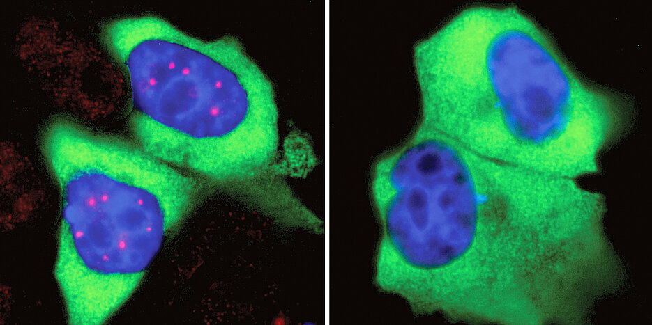 SMN is concentrated in the Cajal bodies (left, red) in the nucleus of human cells (blue). If phosphorylation of SMN is inhibited, the concentration ceases and Cajal bodies disappear. 