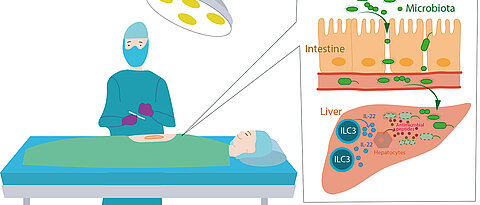 After surgery, bacteria from the intestine can enter the organism. Special cells of the immune system located in the liver fight them. (Graphic: Mercedes Gomez de Aguero)