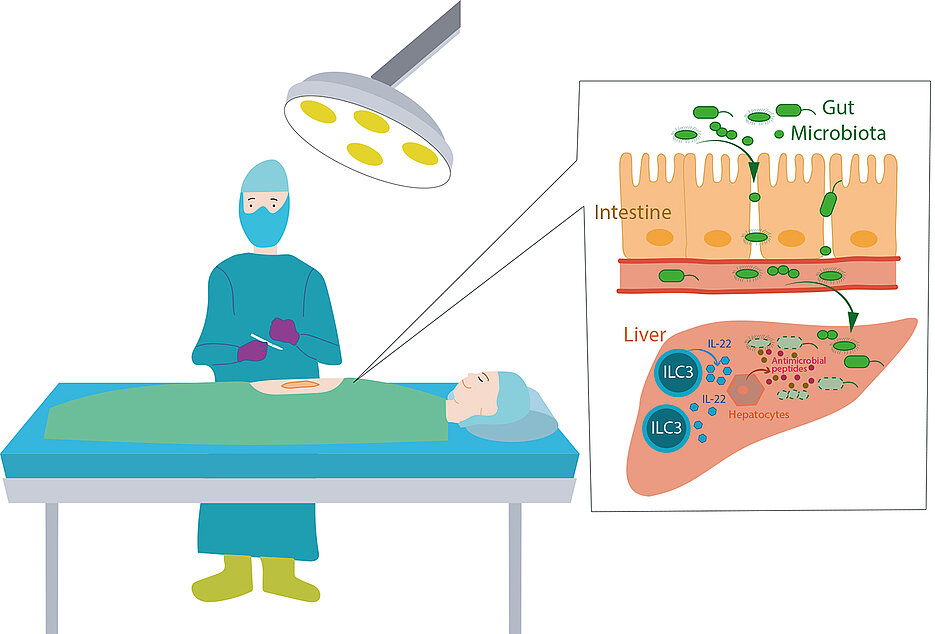 After surgery, bacteria from the intestine can enter the organism. Special cells of the immune system located in the liver fight them. (Graphic: Mercedes Gomez de Aguero)