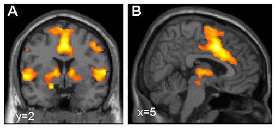 Aktivierung des Furchtnetzes im Gehirn, dargestellt mittels funktioneller Kernspintomografie (Bild: Dr. Tina Lonsdorf, Systemische Neurowissenschaften UKE Hamburg)