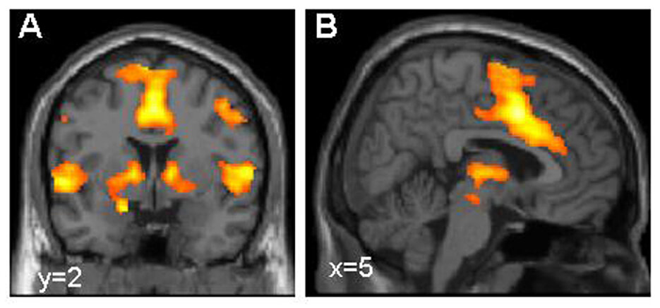 Activation of the brain's fear network, visualized using functional magnetic resonance imaging (picture: Dr. Tina Lonsdorf, Systems Neuroscience UKE Hamburg)