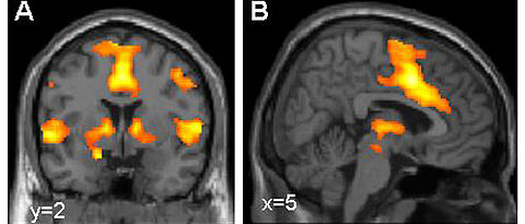 Aktivierung des Furchtnetzes im Gehirn, dargestellt mittels funktioneller Kernspintomografie (Bild: Dr. Tina Lonsdorf, Systemische Neurowissenschaften UKE Hamburg)