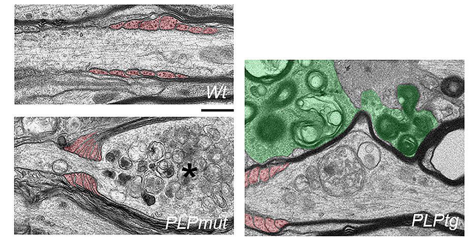 Elektronenmikroskopische Aufnahmen von Axonen in der weißen Substanz von gesunden Kontroll-Mäusen (links oben) und von Mäusen mit verschiedenen Myelin-Gendefekten. Axone, die mit abnormem Myelin umwickelt bleiben (links unten), werden von Fortsätzen der Oligodendrozyten (rot gefärbt) eingeschnürt und weisen Merkmale der Degeneration auf (Stern). Im Gegensatz dazu haben Axone, deren Myelin durch Mikroglia (grün gefärbt, rechtes Bild) entfernt wird, eine höhere Chance zu überleben. Größenmaßstab: 0,5 µm. 