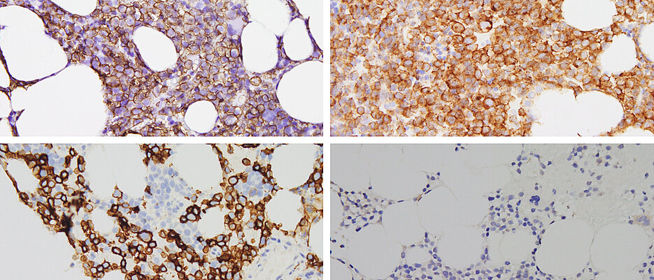 CD138-positive Myelomzellen, die vor der Behandlung mit Talquetamab das Transmembranprotein GPRC5D auf der Oberfläche tragen (oben). Beim Rezidiv nach der Behandlung mit dem bispezifischen Antikörper ist das Antigen verloren gegangen ist (unten).  