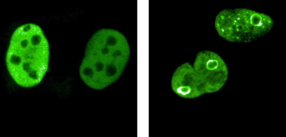 MYC proteins are coloured green in this figure. In normally growing cells, they are homogeneously distributed in the cell nucleus (left). In diverse stress situations, as they occur in cancer cells, they rearrange themselves, form sphere-like structures and thus surround particularly vulnerable sections of the genome.