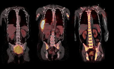 Zusätzlich zu den üblichen Knochenmarkproben aus dem Becken wurden für die Analyse der Myelomzellen bildgebende Verfahren wie hier die Positronen-Emissions-Tomografie (PET) genutzt, um gezielt Proben aus den Tumorherden zu nehmen.