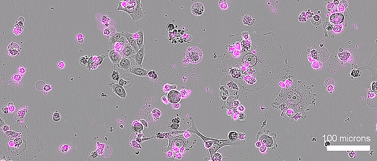 Nach einer Behandlung mit Cas12a2 sterben menschliche Gebärmutterhalskrebszellen (grau dargestellt) großflächig ab, erkennbar an den Apoptose-Markern (magenta).