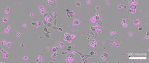 Human cervical cancer cells (shown in gray) undergo widespread cell death after Cas12a2 treatment, as indicated by markers of apoptosis (in magenta).