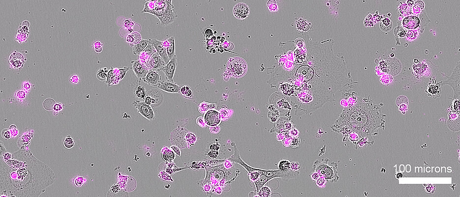 Human cervical cancer cells (shown in gray) undergo widespread cell death after Cas12a2 treatment, as indicated by markers of apoptosis (in magenta).