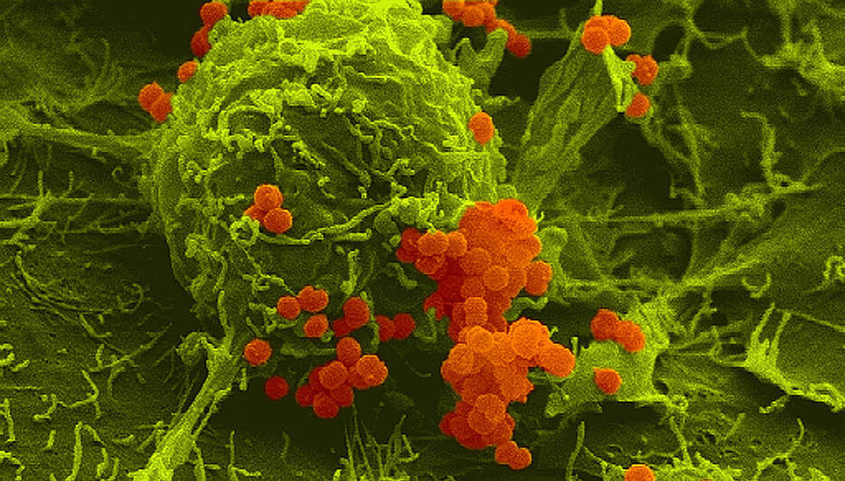 False color scanning electron micrograph of meningococci (orange) adherent to human host cells (green).